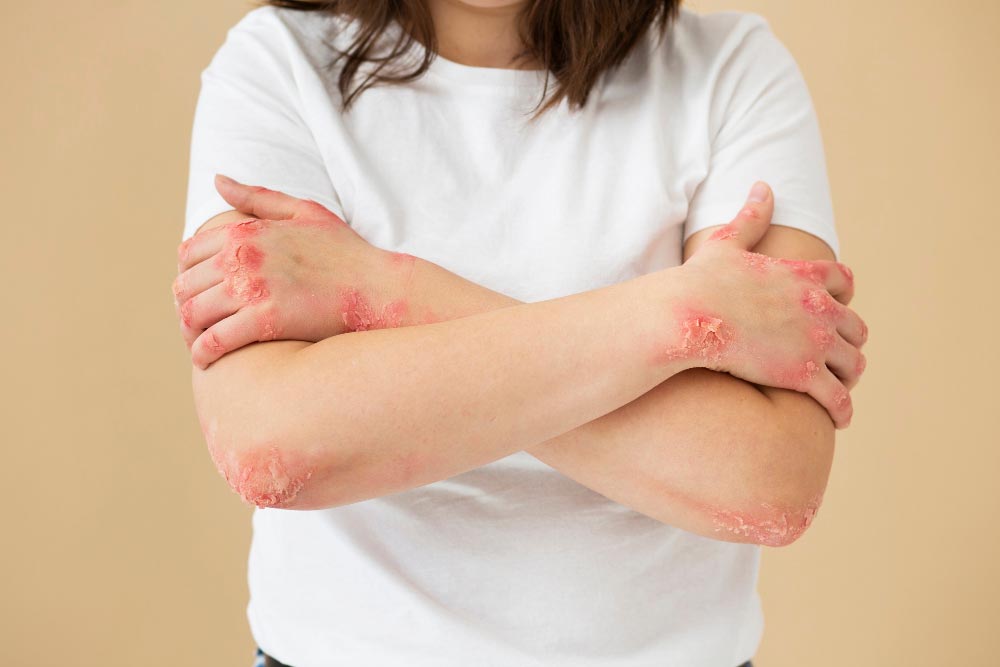woman suffering from psoriasis